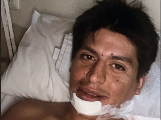 Operado con xito Diego Barzola de la fractura de mandbula